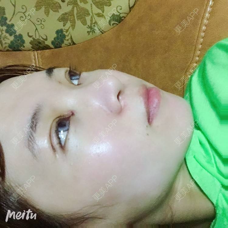 更美 - 更美用户6d6gGsAMox的双眼皮经验 | 双眼皮 | 石家庄