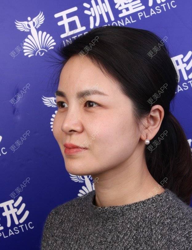 更美 - 武汉五洲整形外科医院的埋线提升经验 | 埋线提升 | 武汉