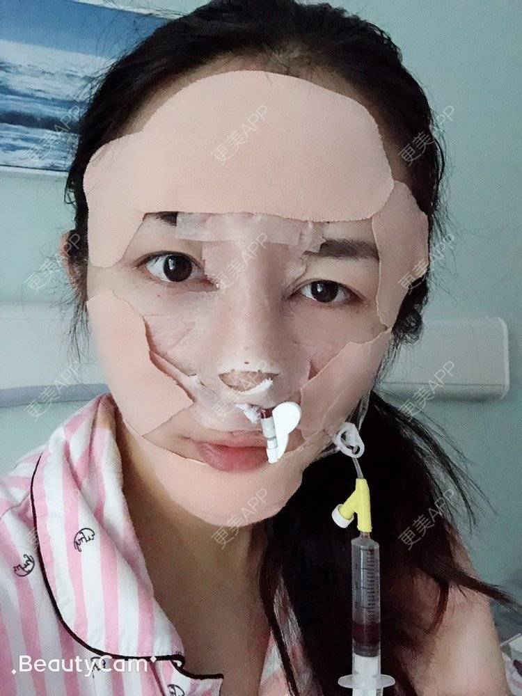 更美 - 云南华美美莱美容医院的隆鼻经验 | 隆鼻 | 昆明 | 鼻部多项