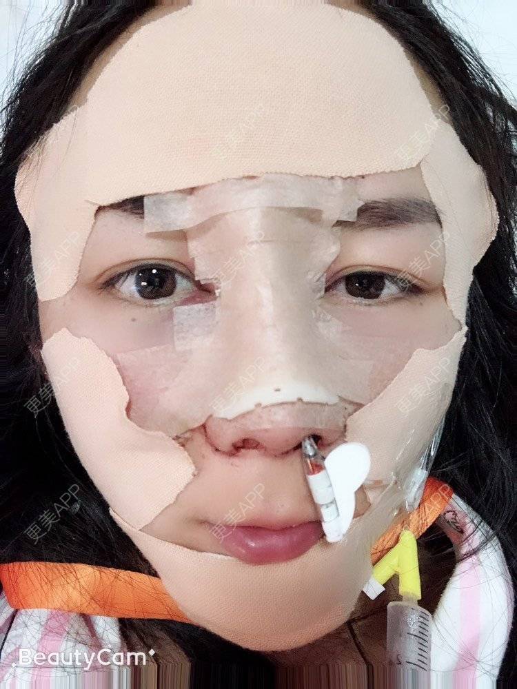 更美 - 云南华美美莱美容医院的隆鼻经验 | 隆鼻 | 昆明 | 鼻部多项