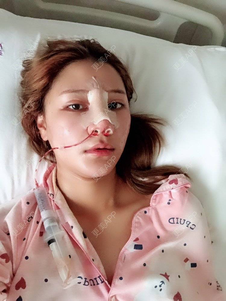 更美 - 云南华美美莱美容医院的隆鼻经验 | 隆鼻 | 鼻部多项 | 昆明