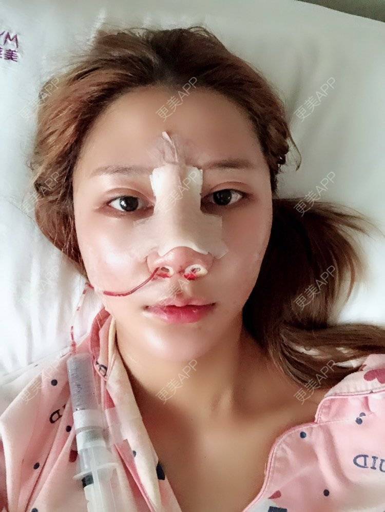 更美 - 云南华美美莱美容医院的隆鼻经验 | 隆鼻 | 鼻部多项 | 昆明