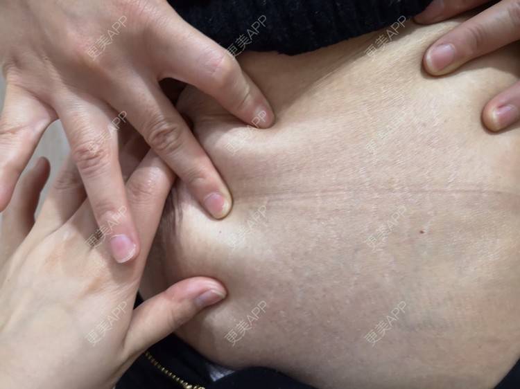 纽钮钮的激光淡化妊娠纹日记