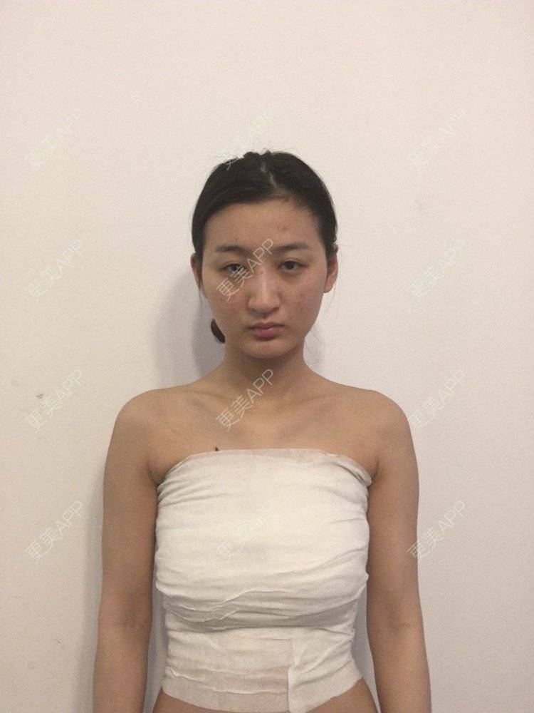 自体脂肪隆胸 | 胶原蛋白丰胸 | 假体隆胸 | 玻尿酸填充隆胸 | 丰胸