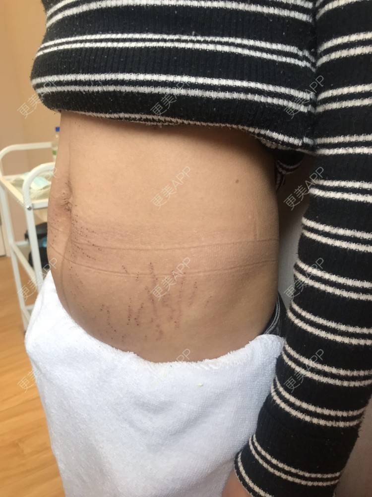 纽钮钮的激光淡化妊娠纹日记