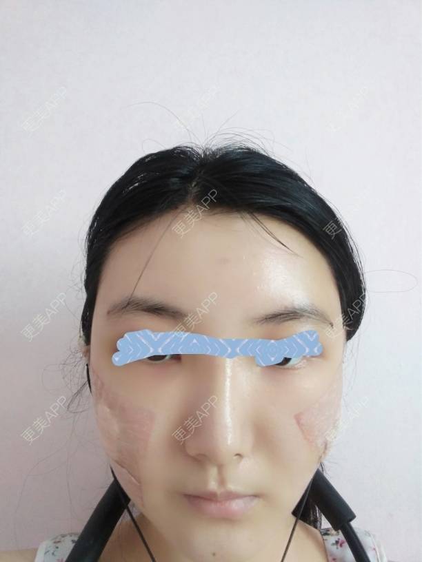 更美 - 更美用户EBRrEIgptp的颧骨颧弓经验 | 颧骨颧弓 | 郑州
