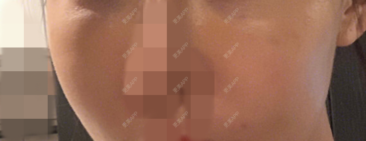 更美 - 更美用户5rDBoH8mJq的自体脂肪丰苹果肌经验 | 自体脂肪丰苹果肌 | 北京