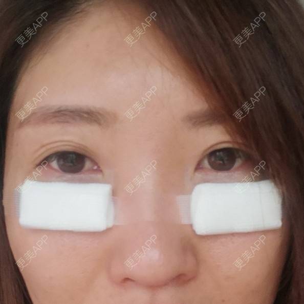 更美 - 更美用户82758634的激光去眼袋经验 | 激光去眼袋 | 上海