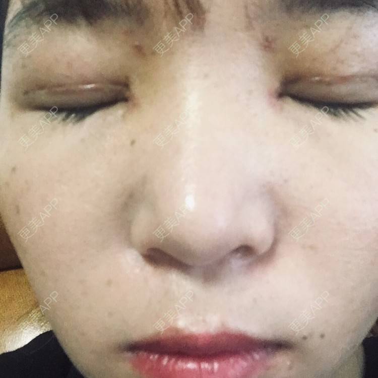 更美 - 更美用户6d6gGsAMox的双眼皮经验 | 双眼皮 | 石家庄