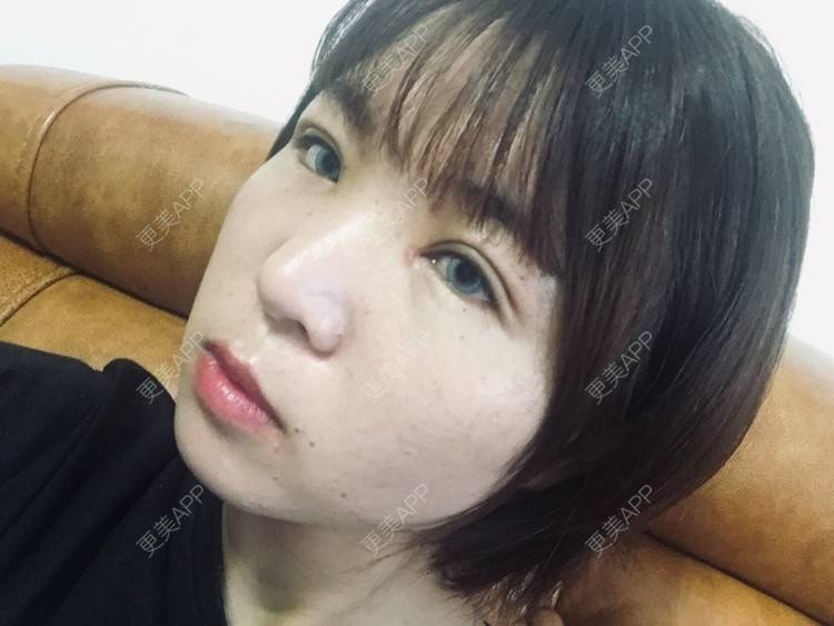 更美 - 更美用户6d6gGsAMox的双眼皮经验 | 双眼皮 | 石家庄