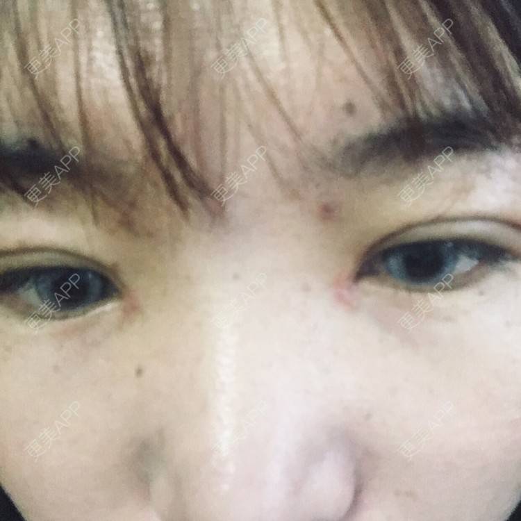 更美 - 更美用户6d6gGsAMox的双眼皮经验 | 双眼皮 | 石家庄