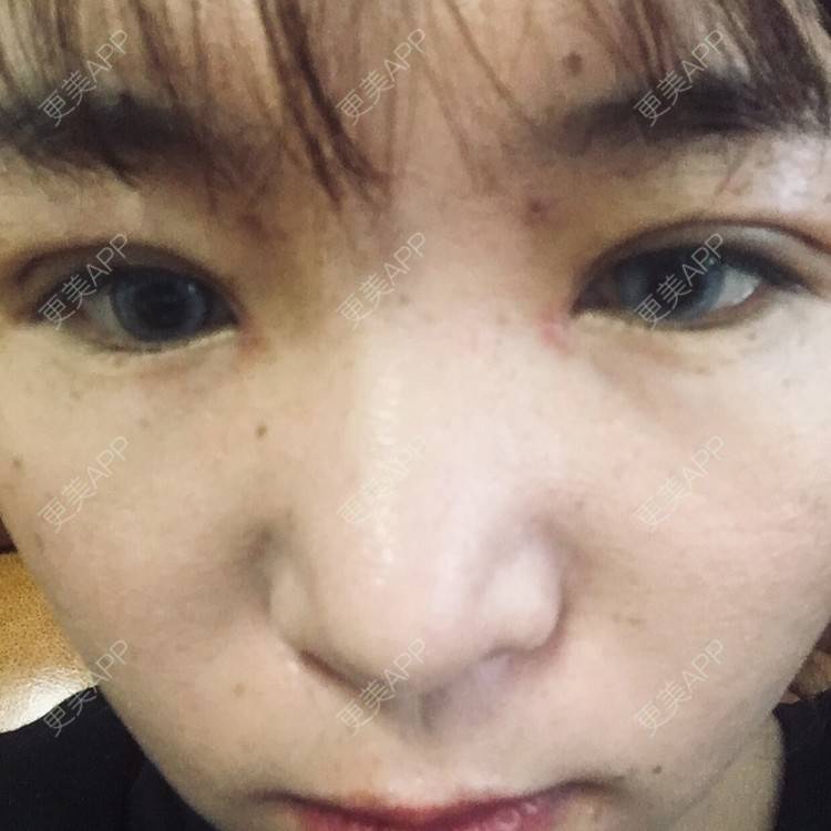 更美 - 更美用户6d6gGsAMox的双眼皮经验 | 双眼皮 | 石家庄