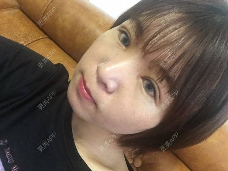 更美 - 更美用户6d6gGsAMox的双眼皮经验 | 双眼皮 | 石家庄