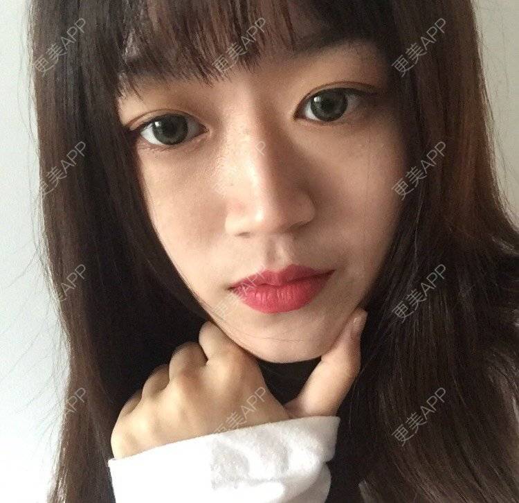 更美 - 妞妞牛小米的鼻部多项经验 | 鼻部多项 | 鼻中隔软骨垫鼻头 | 鼻小柱缩短 | 自体软骨垫鼻尖 | 手术缩鼻头 | 上海 | 全脸整形套餐