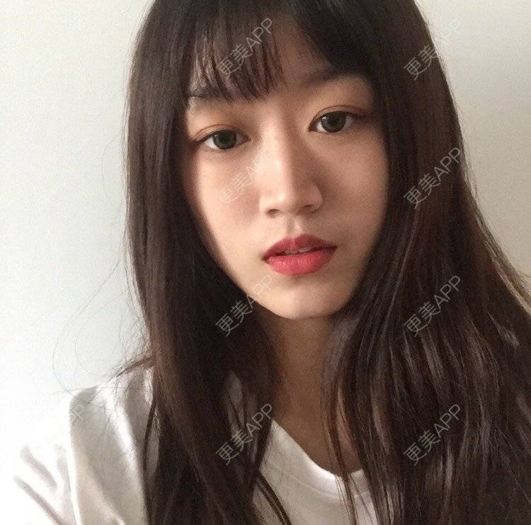 更美 - 妞妞牛小米的鼻部多项经验 | 鼻部多项 | 鼻中隔软骨垫鼻头 | 鼻小柱缩短 | 自体软骨垫鼻尖 | 手术缩鼻头 | 上海 | 全脸整形套餐