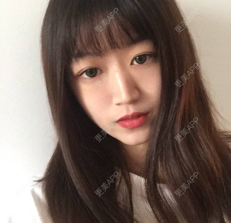 更美 - 妞妞牛小米的鼻部多项经验 | 鼻部多项 | 鼻中隔软骨垫鼻头 | 鼻小柱缩短 | 自体软骨垫鼻尖 | 手术缩鼻头 | 上海 | 全脸整形套餐