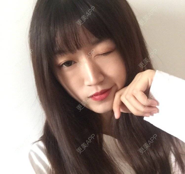 更美 - 妞妞牛小米的鼻部多项经验 | 鼻部多项 | 鼻中隔软骨垫鼻头 | 鼻小柱缩短 | 自体软骨垫鼻尖 | 手术缩鼻头 | 上海 | 全脸整形套餐