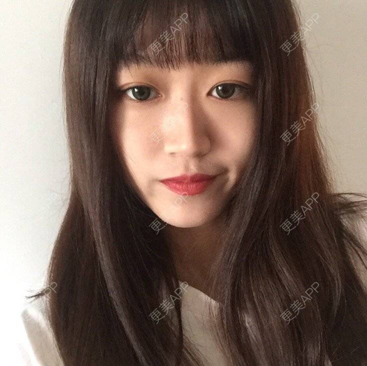 更美 - 妞妞牛小米的鼻部多项经验 | 鼻部多项 | 鼻中隔软骨垫鼻头 | 鼻小柱缩短 | 自体软骨垫鼻尖 | 手术缩鼻头 | 上海 | 全脸整形套餐
