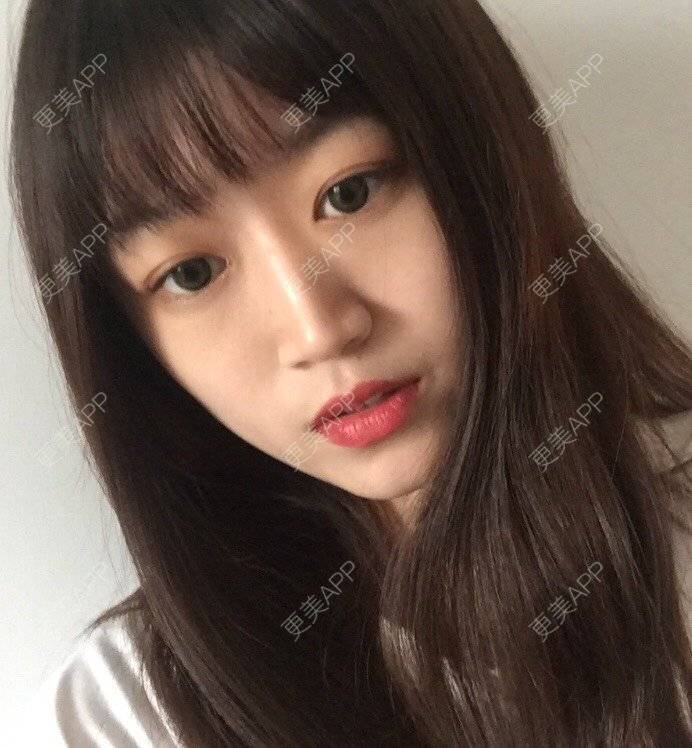 更美 - 妞妞牛小米的鼻部多项经验 | 鼻部多项 | 鼻中隔软骨垫鼻头 | 鼻小柱缩短 | 自体软骨垫鼻尖 | 手术缩鼻头 | 上海 | 全脸整形套餐