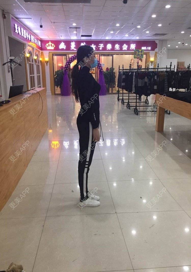 更美 - mylog的腰腹吸脂经验 | 自体脂肪丰臀 | 吸脂塑臀 | 胶原蛋白丰臀 | 假体丰臀 | 射频溶脂塑臀 | 腰腹吸脂 | 天津