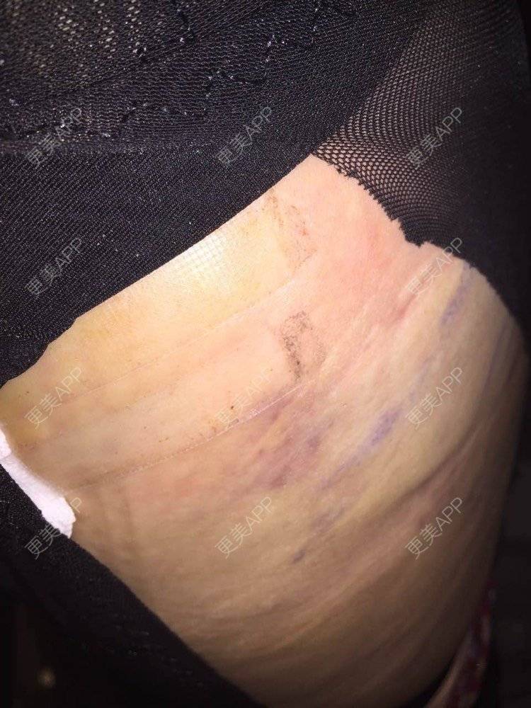 更美 - mylog的腰腹吸脂经验 | 自体脂肪丰臀 | 吸脂塑臀 | 胶原蛋白丰臀 | 假体丰臀 | 射频溶脂塑臀 | 腰腹吸脂 | 天津