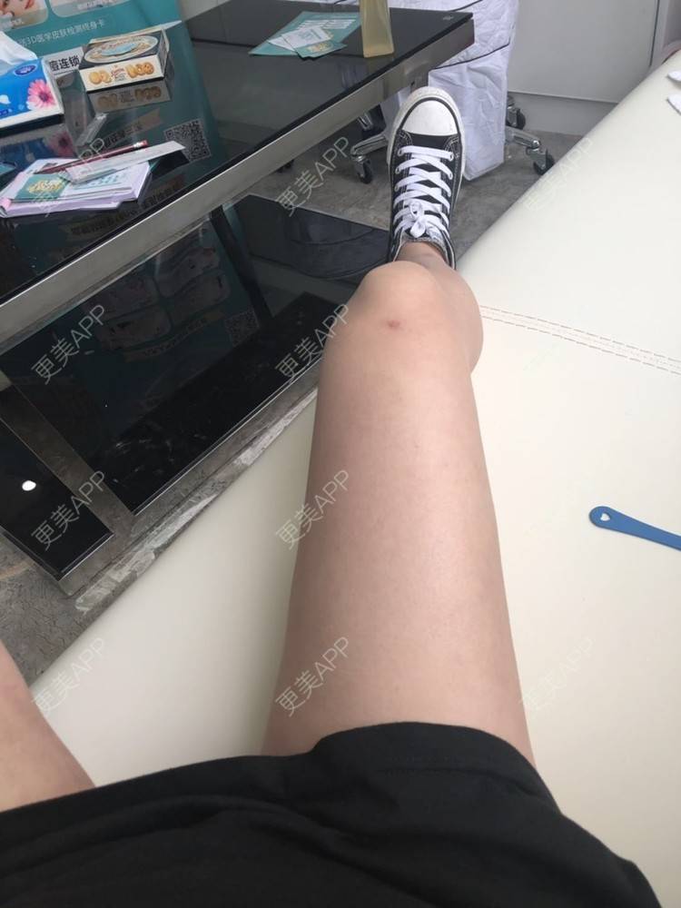 更美用户rdmwnjfsxo的吸脂瘦大腿日记