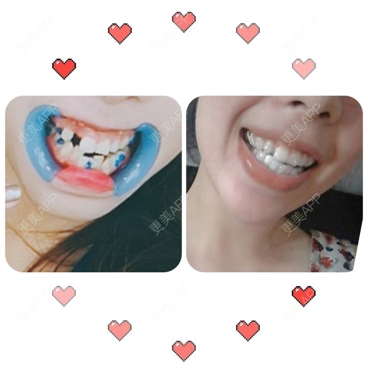 更美 - 西瓜西瓜圓又大🍉的隐形牙齿矫正经验 | 上海 | 隐形牙齿矫正