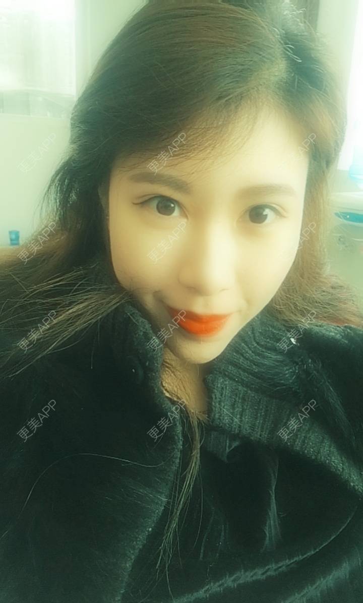 更美 - 西瓜西瓜圓又大🍉的隐形牙齿矫正经验 | 上海 | 隐形牙齿矫正