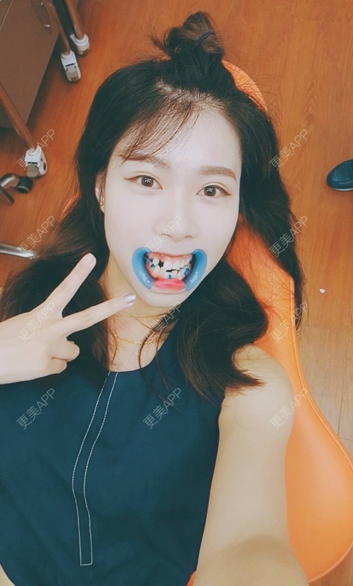 更美 - 西瓜西瓜圓又大🍉的隐形牙齿矫正经验 | 上海 | 隐形牙齿矫正