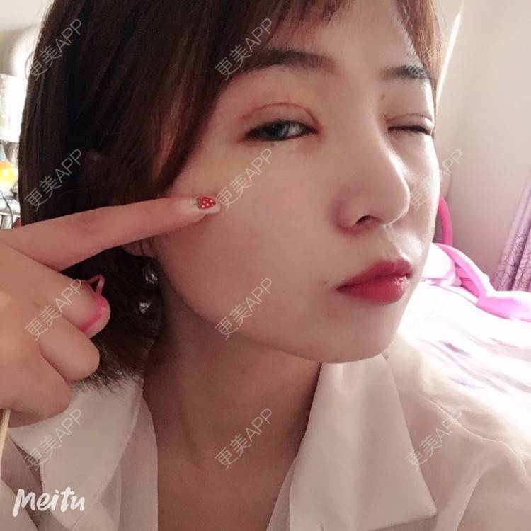 更美 - 更美用户6d6gGsAMox的双眼皮经验 | 双眼皮 | 石家庄