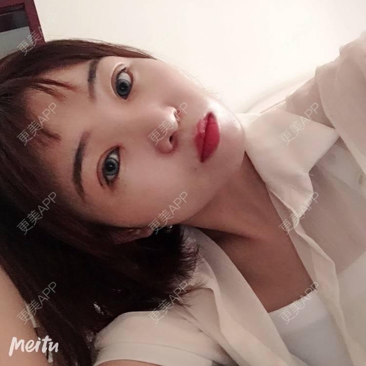 更美 - 更美用户6d6gGsAMox的双眼皮经验 | 双眼皮 | 石家庄