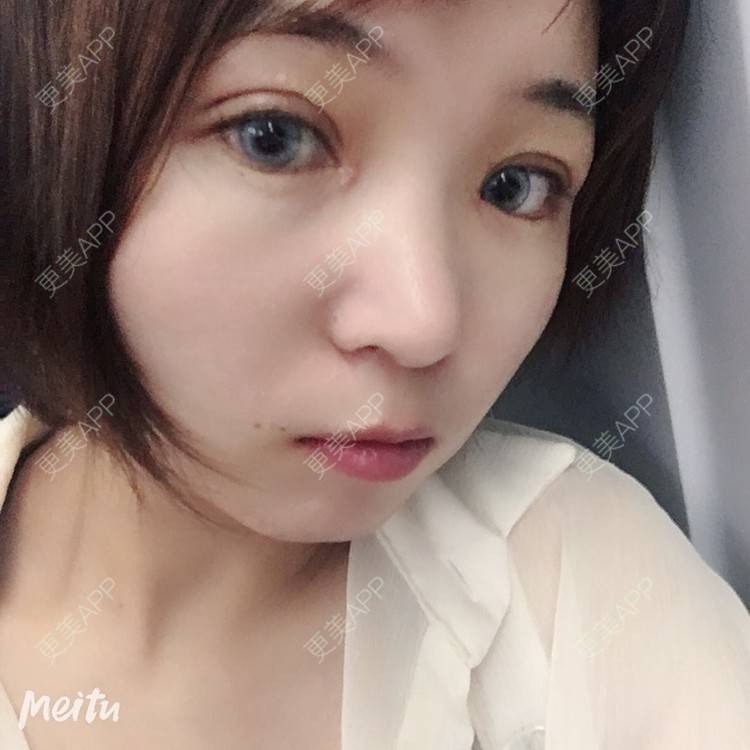 更美 - 更美用户6d6gGsAMox的双眼皮经验 | 双眼皮 | 石家庄