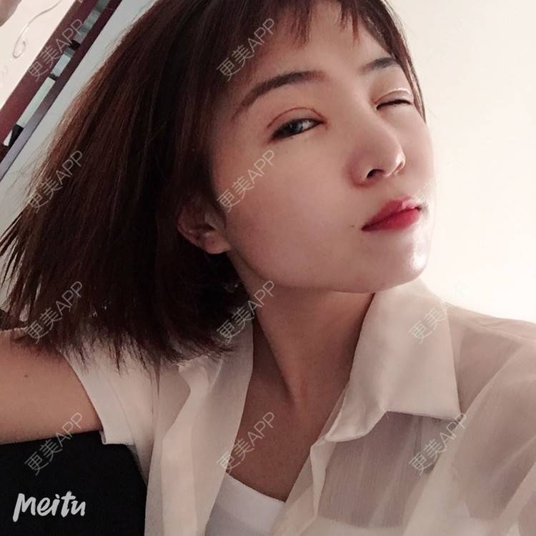 更美 - 更美用户6d6gGsAMox的双眼皮经验 | 双眼皮 | 石家庄