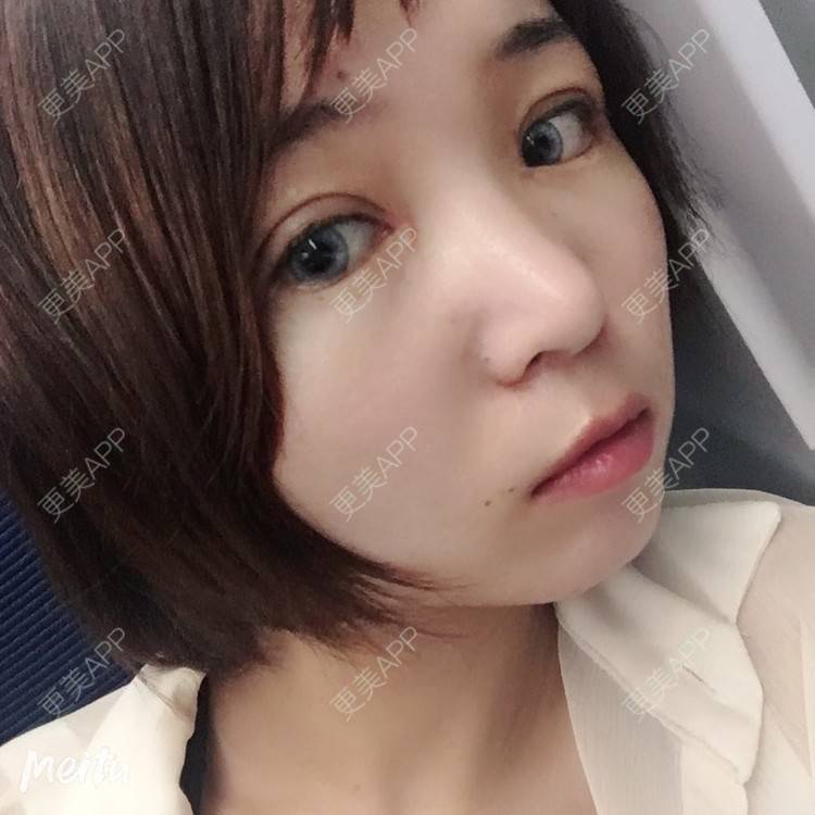 更美 - 更美用户6d6gGsAMox的双眼皮经验 | 双眼皮 | 石家庄