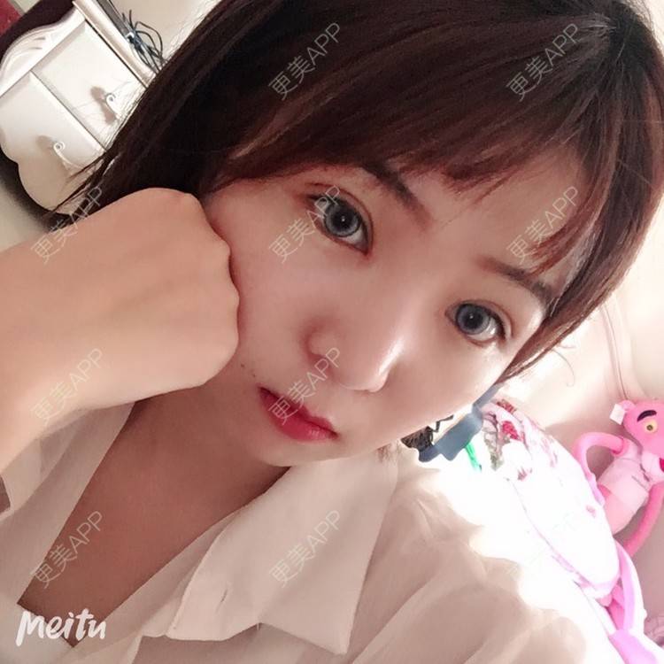 更美 - 更美用户6d6gGsAMox的双眼皮经验 | 双眼皮 | 石家庄