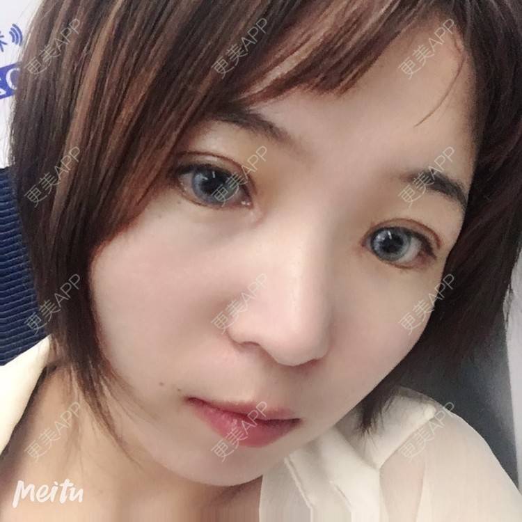 更美 - 更美用户6d6gGsAMox的双眼皮经验 | 双眼皮 | 石家庄