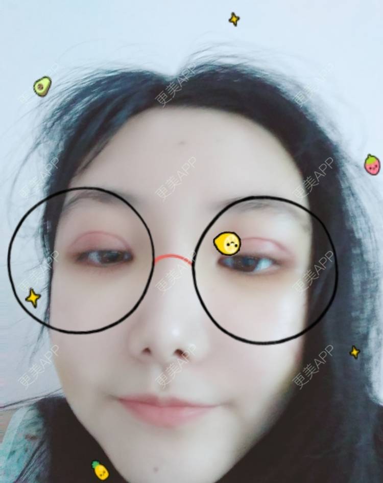 更美 - 更美用户EBRrEIgptp的颧骨颧弓经验 | 颧骨颧弓 | 郑州