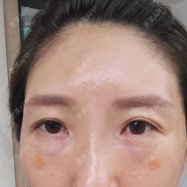 更美 - 更美用户82758634的激光去眼袋经验 | 激光去眼袋 | 上海