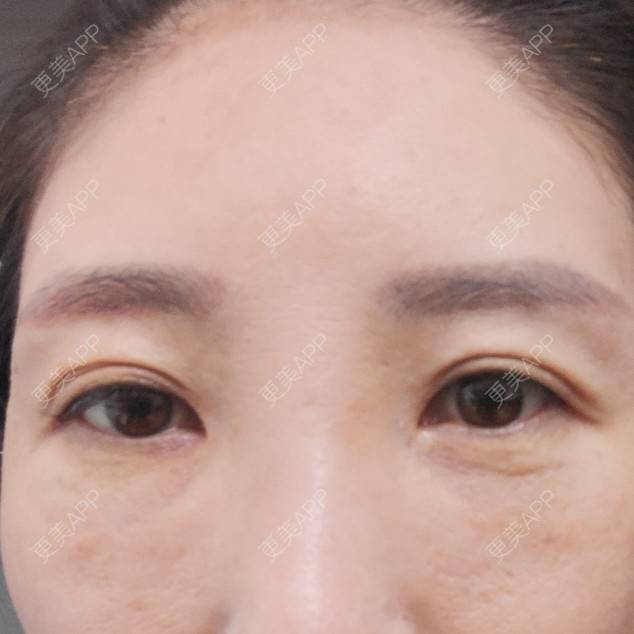 更美 - 更美用户82758634的激光去眼袋经验 | 激光去眼袋 | 上海