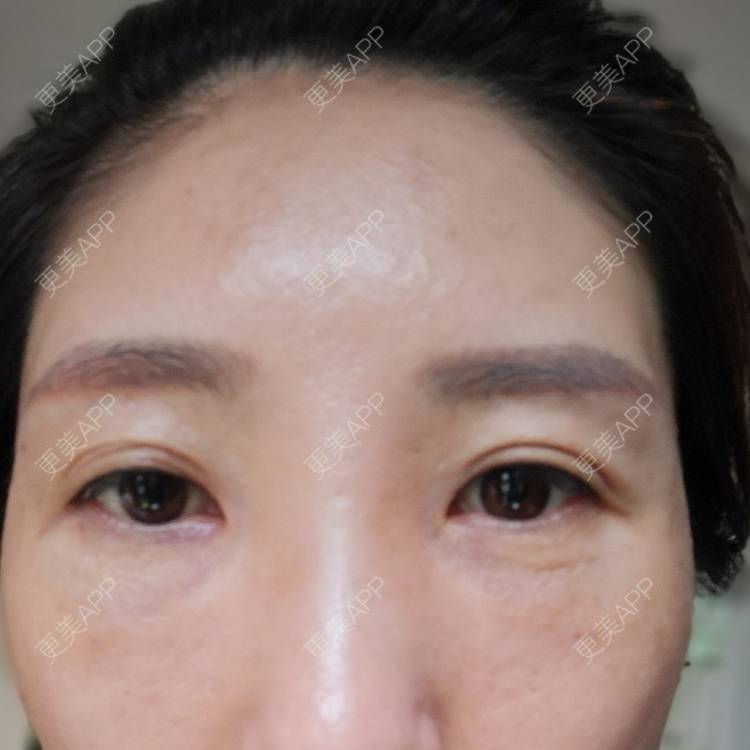 更美 - 更美用户82758634的激光去眼袋经验 | 激光去眼袋 | 上海