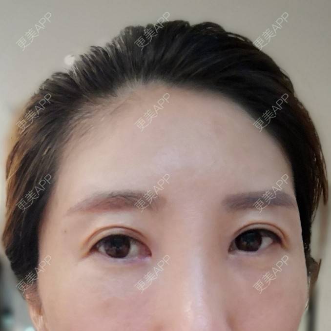 更美 - 更美用户82758634的激光去眼袋经验 | 激光去眼袋 | 上海