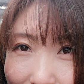 更美 - 更美用户82758634的激光去眼袋经验 | 激光去眼袋 | 上海