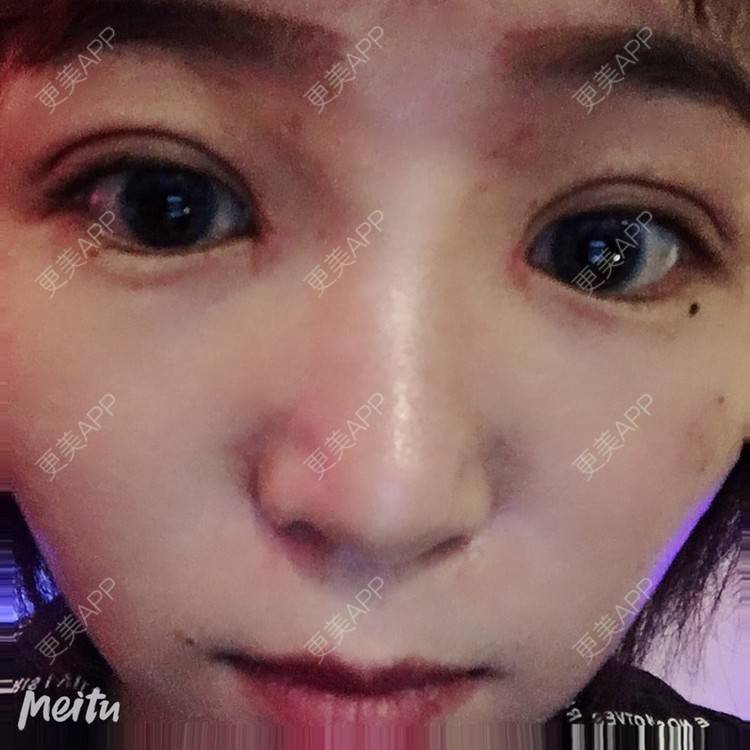 更美 - 更美用户6d6gGsAMox的双眼皮经验 | 双眼皮 | 石家庄