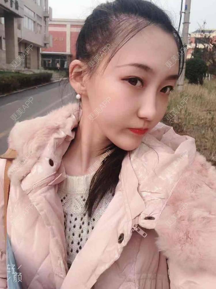 更美 - 王殿峰 医生的玻尿酸下巴经验 | 玻尿酸下巴 | 大连