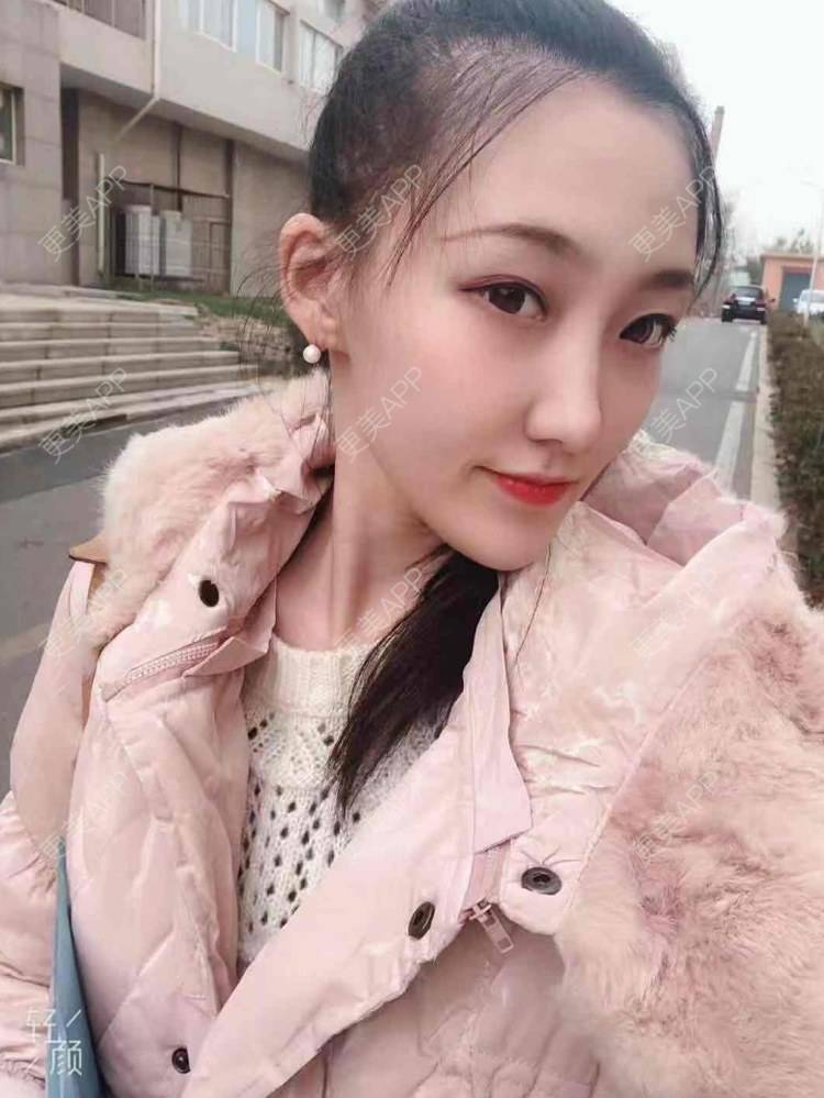 更美 - 王殿峰 医生的玻尿酸下巴经验 | 玻尿酸下巴 | 大连