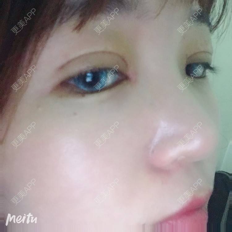 更美 - 更美用户6d6gGsAMox的双眼皮经验 | 双眼皮 | 石家庄