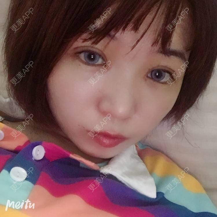 更美 - 更美用户6d6gGsAMox的双眼皮经验 | 双眼皮 | 石家庄