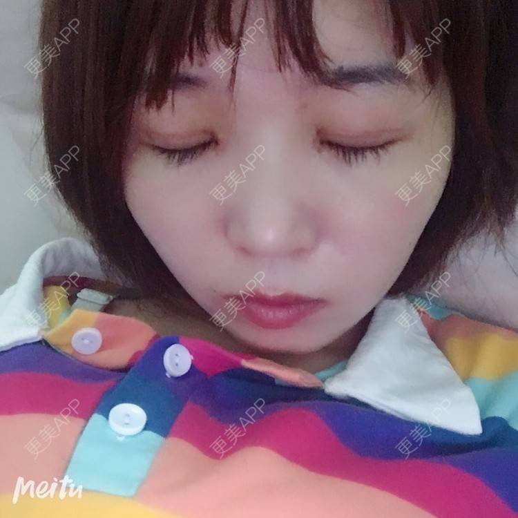 更美 - 更美用户6d6gGsAMox的双眼皮经验 | 双眼皮 | 石家庄