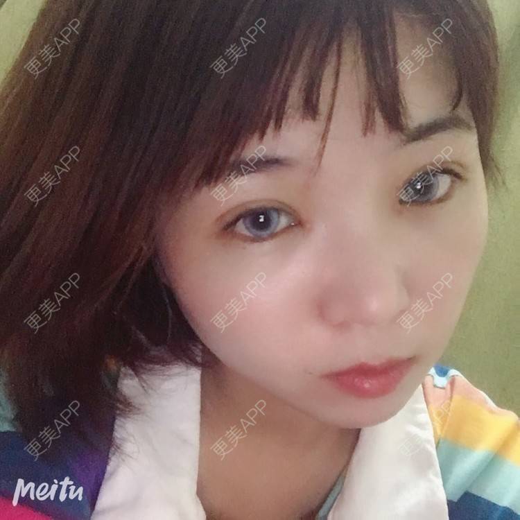 更美 - 更美用户6d6gGsAMox的双眼皮经验 | 双眼皮 | 石家庄