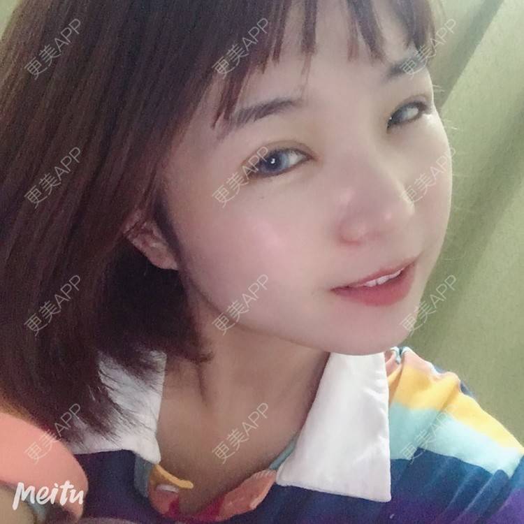 更美 - 更美用户6d6gGsAMox的双眼皮经验 | 双眼皮 | 石家庄